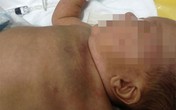 Bé trai hai tháng tuổi bị bạo hành dã man Bé trai hai tháng tuổi bị bạo hành dã man