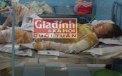 Vợ chồng thầy giáo bỏng nặng sau trận "tỉ thí" bằng lửa Vợ chồng thầy giáo bỏng nặng sau trận "tỉ thí" bằng lửa