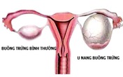 Bị u nang buồng trứng sẽ khó có con? Bị u nang buồng trứng sẽ khó có con?