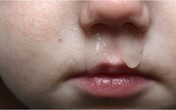 Chảy nước mũi, ho đờm xanh không cần dùng kháng sinh Chảy nước mũi, ho đờm xanh không cần dùng kháng sinh