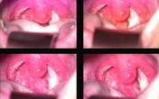 Phòng ngừa viêm họng cấp lúc chuyển mùa Phòng ngừa viêm họng cấp lúc chuyển mùa