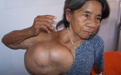 Phẫu thuật cho người có khối u khổng lồ Phẫu thuật cho người có khối u khổng lồ