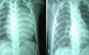 Cứu sống bệnh nhi 2 tuổi bị bệnh tim hiếm gặp Cứu sống bệnh nhi 2 tuổi bị bệnh tim hiếm gặp