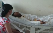 Mồi thuốc lá bên chai cồn, hai vợ chồng bỏng nặng Mồi thuốc lá bên chai cồn, hai vợ chồng bỏng nặng