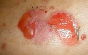 Cô gái mắc bệnh viêm da hiếm gặp Cô gái mắc bệnh viêm da hiếm gặp