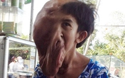 Nỗi đau người con gái 'đầu to, một mắt' Nỗi đau người con gái 'đầu to, một mắt'
