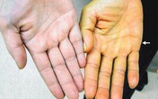 Những thay đổi trên da báo hiệu bệnh gan Những thay đổi trên da báo hiệu bệnh gan