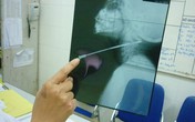 Bé 5 tuổi ngã bị kim đâm xuyên cổ Bé 5 tuổi ngã bị kim đâm xuyên cổ