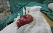 Kinh hãi bé 13 tuổi bị tăm tre đâm thủng ruột Kinh hãi bé 13 tuổi bị tăm tre đâm thủng ruột