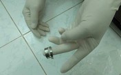 Suýt mất “của quý” vì đeo nhẫn không đúng chỗ Suýt mất “của quý” vì đeo nhẫn không đúng chỗ