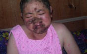 Người phụ nữ khốn khổ bởi vảy nến lở loét toàn thân Người phụ nữ khốn khổ bởi vảy nến lở loét toàn thân