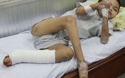 Chàng trai rụng dần tứ chi bởi căn bệnh lần đầu có ở VN Chàng trai rụng dần tứ chi bởi căn bệnh lần đầu có ở VN