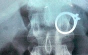 Nuốt nhẫn, vòng vàng để tẩu tán tang vật Nuốt nhẫn, vòng vàng để tẩu tán tang vật