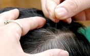 Đoán sức khỏe qua vị trí tóc bạc mọc Đoán sức khỏe qua vị trí tóc bạc mọc