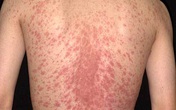 Tẩy sạch các bệnh vẩy trên da bằng những sản phẩm thiên nhiên Tẩy sạch các bệnh vẩy trên da bằng những sản phẩm thiên nhiên