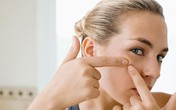 Đừng để bị mụn do căng thẳng! Đừng để bị mụn do căng thẳng!