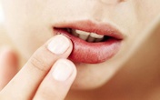 Giải quyết môi khô nứt nẻ bằng những cách đơn giản Giải quyết môi khô nứt nẻ bằng những cách đơn giản