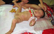 Bất hạnh bé 14 tháng không có hậu môn, bàng quang lồi trên ổ bụng Bất hạnh bé 14 tháng không có hậu môn, bàng quang lồi trên ổ bụng