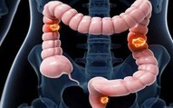 Nam sinh viên 22 tuổi mắc ung thư đại tràng giai đoạn 4 thừa nhận bỏ qua 3 dấu hiệu báo bệnh này
