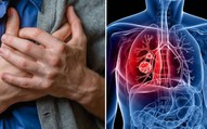 Người phụ nữ 55 tuổi bất ngờ phát hiện ung thư phổi giai đoạn sớm từ việc nhiều người Việt bỏ qua