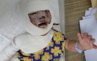 Hình ảnh mới của bé gái bị ngã vào bếp lửa khiến biến dạng khuôn mặt