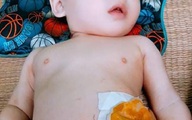 Xót xa bé trai hơn tuổi dị tật bàng quang ngoài bẩm sinh, không có hậu môn