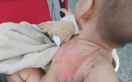 Bé 2 tuổi bị bỏng nước sôi pha mì tôm khi đùa cùng anh trai