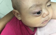 Xót thương bé trai dân tộc Nùng 7 tháng tuổi bị khối u đẩy lồi mắt ra ngoài