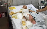 Nỗi đau tột cùng của cậu bé dân tộc bị bỏng nặng toàn thân
