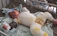 Xót xa cậu bé 3 tuổi khổ sở vì di chứng bỏng nước sôi kinh hoàng