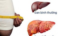 Dấu hiệu gan nhiễm mỡ có quá nguy hiểm?