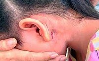 Vi khuẩn 'ăn thịt người' Whitmore khiến nữ sinh tử vong nguy hiểm thế nào? Cần làm gì để phòng bệnh?