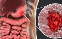 Người phụ nữ 41 tuổi phát hiện ung thư dạ dày từ dấu hiệu rối loạn tiêu hóa mà nhiều người Việt vẫn xem nhẹ