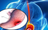 Phát hiện ung thư từ dấu hiệu chóng mặt