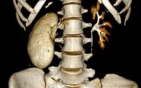Cô gái 18 tuổi có thận 'hóa đá' và những sai lầm tàn phá thận một cách nhanh chóng của nhiều người