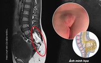 Bé 10 tuổi ở Phú Thọ bị dị tật tủy sống từ dấu hiệu nhiều người Việt bỏ qua