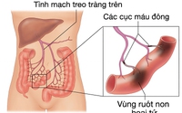 Phát hiện 'thủ phạm' gây tắc tĩnh mạch sau 7 lần mổ hoại tử ruột