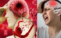 Xuất huyết não thường xảy ra vào 10 'thời điểm' nguy hiểm này: Những dấu hiệu nên đến viện ngay lập tức!