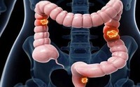 Nam sinh viên 22 tuổi mắc ung thư đại tràng giai đoạn 4 thừa nhận bỏ qua 3 dấu hiệu báo bệnh này