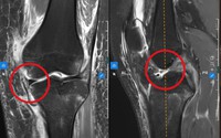 Nữ sinh 16 tuổi đứt cùng lúc 3 dây chằng sau cú ngã xe điện