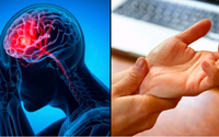 Dấu hiệu nguy hiểm nhất của đột quỵ không phải tê tay chân, nhiều người vẫn đang hiểu lầm
