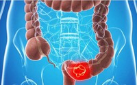 Người đàn ông phát hiện ung thư trực tràng từ dấu hiệu mơ hồ, nhiều người Việt mắc phải đã vô tình bỏ qua