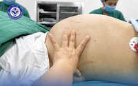 Thiếu nữ 19 tuổi mang khối u buồng trứng khoảng 30cm vì tâm lý chủ quan phụ nữ Việt hay mắc phải