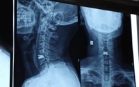 Người đàn ông 43 tuổi đau cổ, tê tay suốt 2 năm vì bệnh lý nhiều người Việt dễ bỏ qua