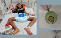 Hai trẻ hôn mê, suy hô hấp: Bác sĩ cảnh báo nguy cơ ngộ độc khi ăn chanh dây chưa chín
