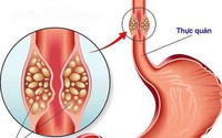Cô gái 26 tuổi bị loét thực quản vì thói quen nhiều người Việt mắc phải khi uống thuốc