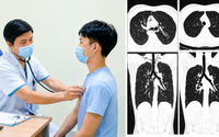 Nam thanh niên 20 tuổi tràn khí trung thất sau 1 tuần ho liên tục, bác sĩ cảnh báo dấu hiệu dễ bị bỏ qua
