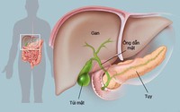 Người phụ nữ 36 tuổi bất ngờ phát hiện đa polyp túi mật khi đi khám giảm cân