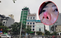 Thảm họa làm đẹp khi đến nhầm chỗ (bài 7): Hành trình 84 ngày của người phụ nữ 53 tuổi ở Hà Nội chống lại nỗi đau sau nâng mũi ở Viện Thẩm mỹ Quốc tế ChangWon