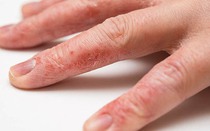 Làm cách nào để khắc phục da tay khô nứt nẻ vào mùa đông?